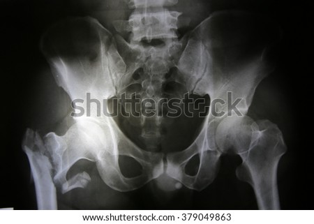 X-ray photos of bone fracture patients