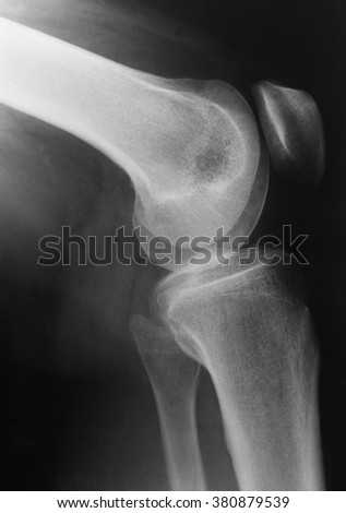 X-ray picture of knee 