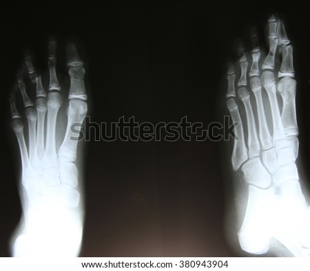 x-ray of foot on black background