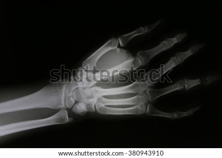 X-ray image of broken forearm, AP and lateral view show fracture of ulna and radius bone