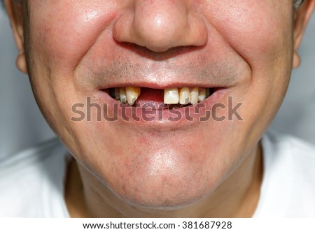 Man smile without two front teeth Royalty-Free Stock Photo #381687928