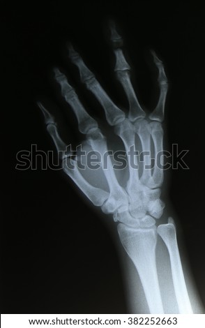 X-ray image of broken forearm, AP and lateral view show fracture of ulna and radius bone
