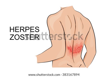 human infection herpes zoster Royalty-Free Stock Photo #383167894