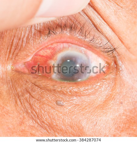 Close up of the acute angel closure glaucoma during eye examination. Royalty-Free Stock Photo #384287074