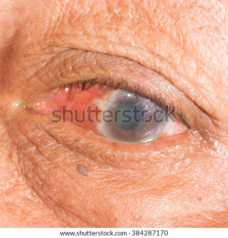 Close up of the acute angel closure glaucoma during eye examination. Royalty-Free Stock Photo #384287170