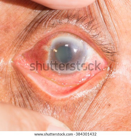 Close up of the acute angel closure glaucoma during eye examination. Royalty-Free Stock Photo #384301432
