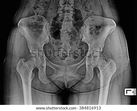 x-ray of hip