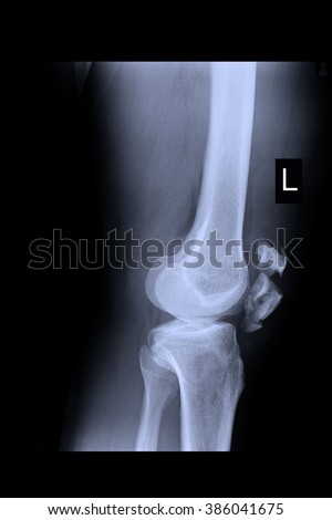 X-Ray show fracture at right knee 

