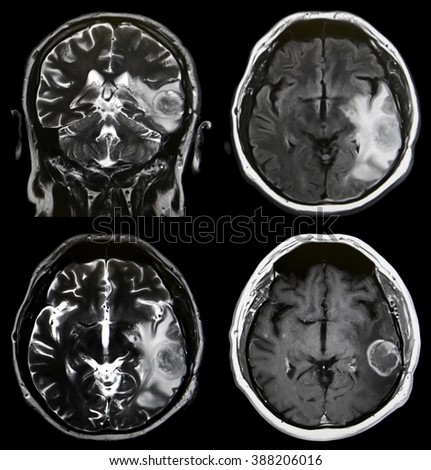 brain tumor, MRI