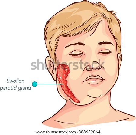 children salivary gland swelling vector illustration