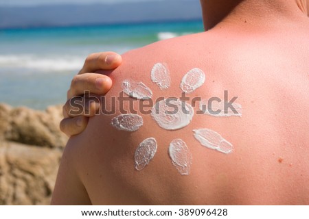 Sunburn and suncream on the shoulder of a young man Royalty-Free Stock Photo #389096428