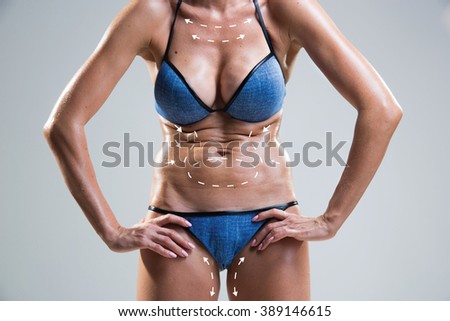 Body correction with the help of plastic surgery . Woman belly marked.