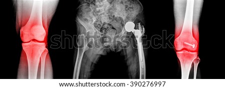X-ray of human knee and hip bone joint