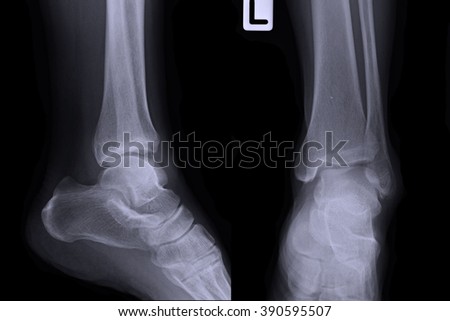 X-ray show left Ankle joint 