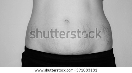European woman belly. Stretch marks on the lower abdomen after child birth.