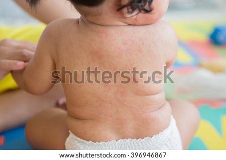 Exanthem subitum, Roseola infantum, Sixth disease, seudo rubella baby sick ( Human herpes virus type 6 HHV6 ) rash on skin  Royalty-Free Stock Photo #396946867