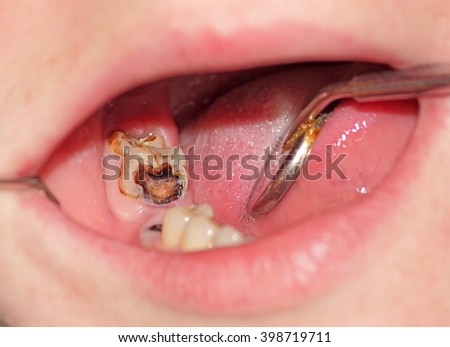 Tooth decay of lower molar. image close-up. Royalty-Free Stock Photo #398719711