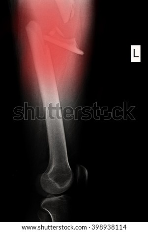Xray Show Fractured Left Femur Royalty-Free Stock Photo #398938114