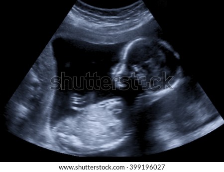 Ultrasound of baby in mother's womb. Royalty-Free Stock Photo #399196027