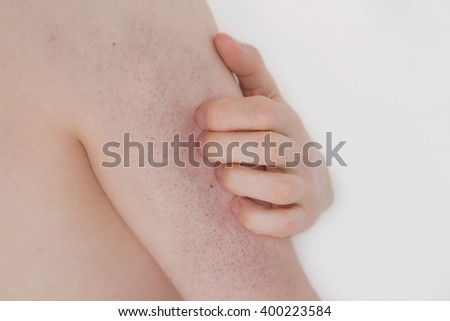 Young man with Keratosis pilaris on his upper arm Royalty-Free Stock Photo #400223584