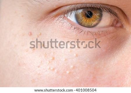 Milia (Milium) - pimples around eye on skin. Royalty-Free Stock Photo #401008504