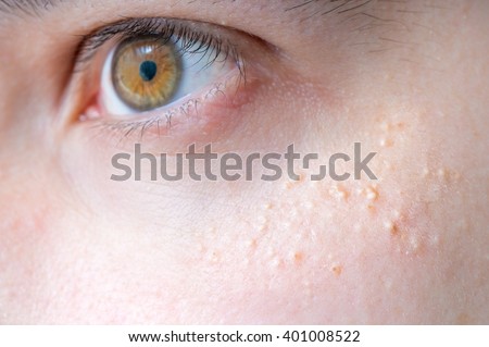 Milia (Milium) - pimples around eye on skin. Royalty-Free Stock Photo #401008522
