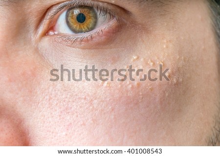 Milia (Milium) - pimples around eye on skin. Royalty-Free Stock Photo #401008543