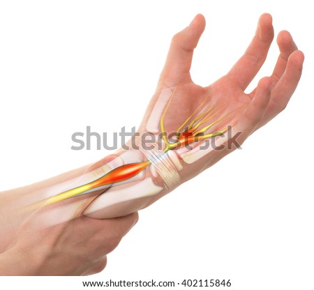 Carpal Tunnel Syndrome - Wrist Pain isolated on white (transparent bones) Royalty-Free Stock Photo #402115846