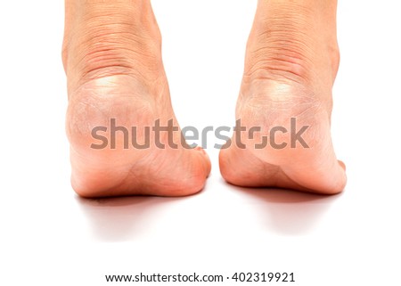 Cracked heels and foot fungus  on white background