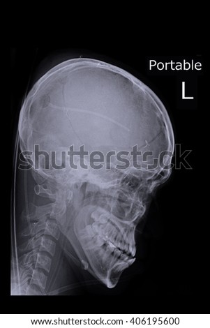 Portable skull