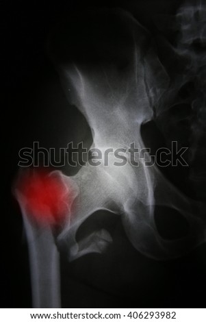 photos of bone fracture  with markpoint