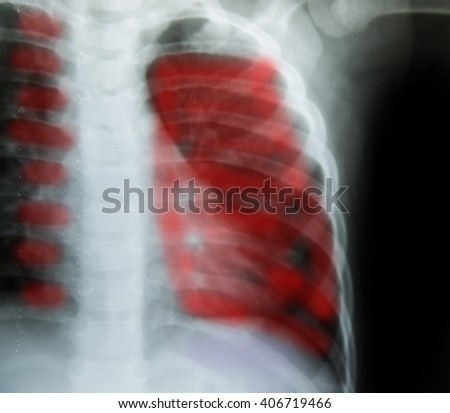 Film X-Ray patient Pulmonary Emphysema in  World No Tobacco Day May 31 concept.