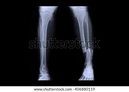 closed fracture left leg , ( Xray both leg )  Royalty-Free Stock Photo #406880119
