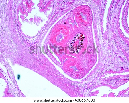 Hydatid cyst of lung caused by tapeworm parasite Echinococcus granulosus, light micrograph, X50