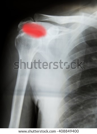 X-ray film of shoulder