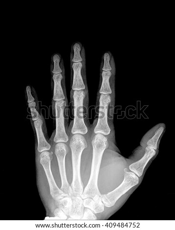 Human hand x-ray - Medical Image.