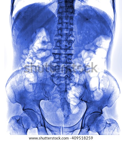 X-ray lumbo-sacral spine and pelvis