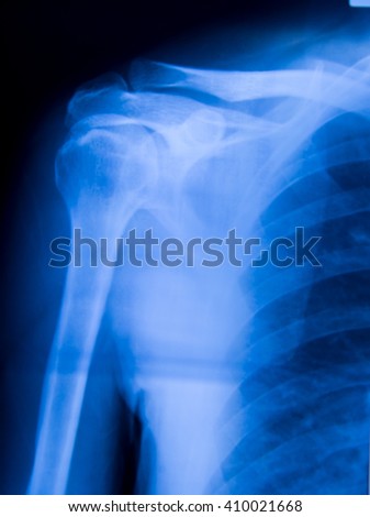 X-ray film of shoulder in blue tone.