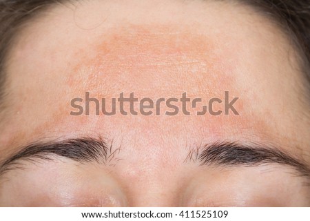 Young woman with pigmented skin Royalty-Free Stock Photo #411525109