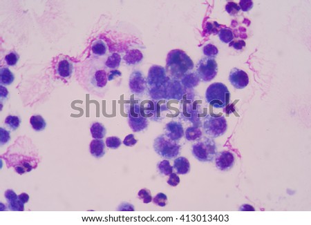 Cancer Cell in human  showing abnormal cells. Royalty-Free Stock Photo #413013403