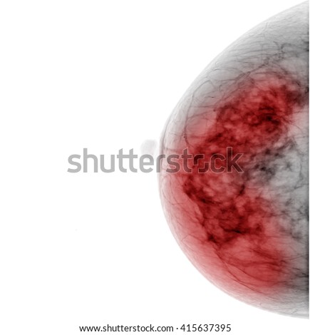 X-ray mammogram image of breast with cancer on white background
