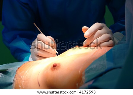Surgeon measuring breast before enhancing the size and shape of a woman's breast.