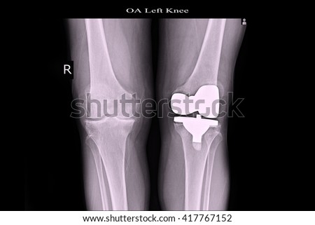 OA Knee, Cemented TKR left Knee, 