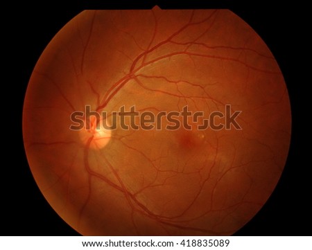 Optical Coherence Tomography (OCT) image of eye in the patient Royalty-Free Stock Photo #418835089
