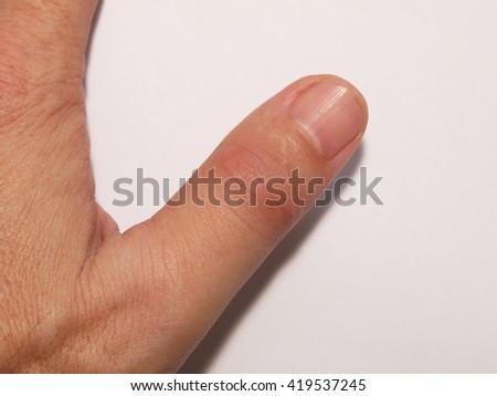 left thumb finger joint get sudden, intense pain in a night without warning looks like gout or rheumatoid symptom, Inflammation, redness, swollen, tender, warm and  limited motion movement