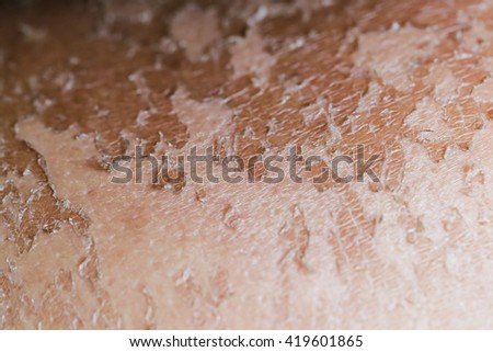 Back view of man with dermatitis problem  itchy dry skin.