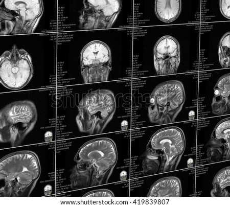 Magnetic resonance imaging of the brain 