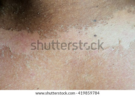 Back view of man with dermatitis problem itchy dry skin.