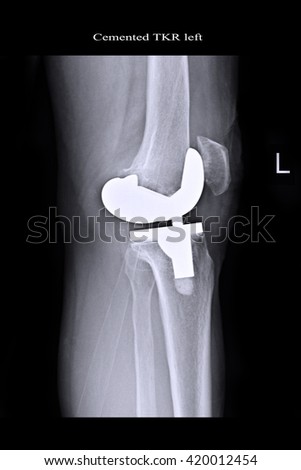 cemented TKR left knee ; OA left knee