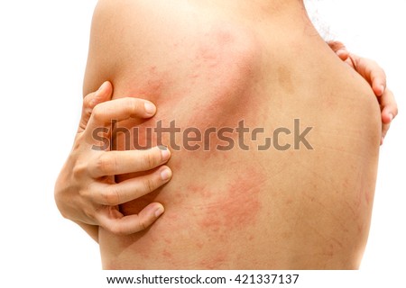 Women with symptoms of itchy urticaria. Royalty-Free Stock Photo #421337137